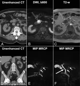 Axial (A, B, C) and coronal (D, E, F) images of a patient presenting with left renal colic.