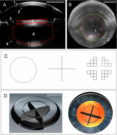 3-D Imaging Guides Femtosecond Laser in Cataracts Removal (5 of 10)