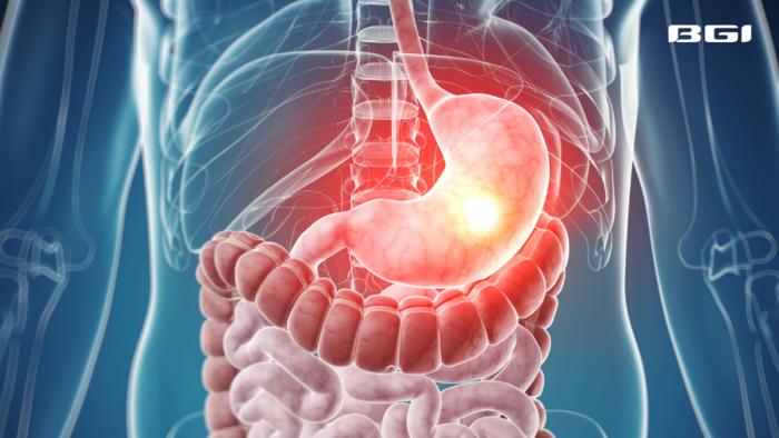 BGI Genomics New study on Advanced Stomach Cancer Treatment