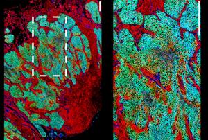 Mapping the Evolution of Urinary Tract Cancer Cells