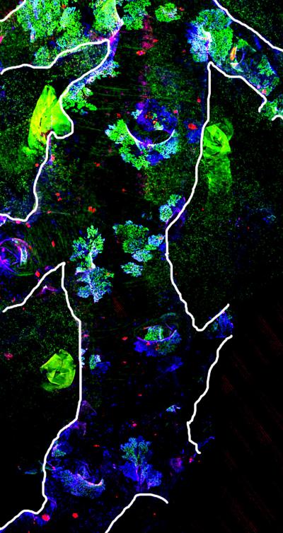 Airway After Severe Injury