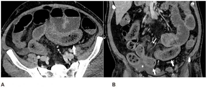 Imaging Reveals Bowel Abnormalities in Patients with COVID-19