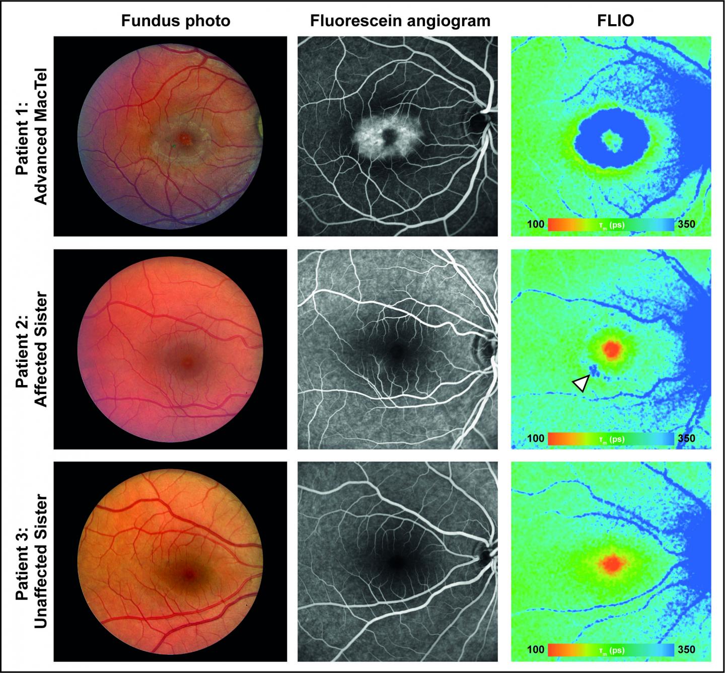 Manifestation of the Rare Eye Disease, MacTel