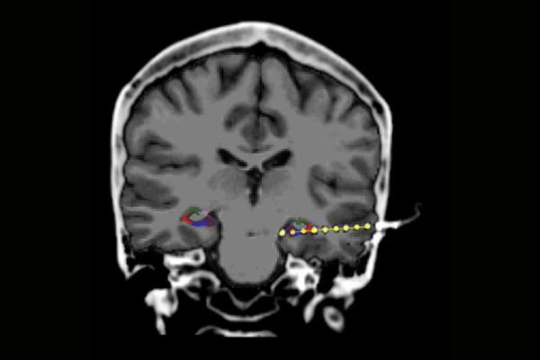 Electrode Implanted in Hippocampus