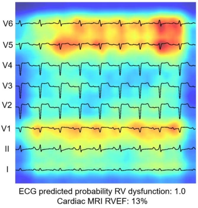 Ai enabled electrocardiogram a image eurekalert science news releases