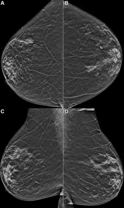 Example mammogram assigned a f [IMAGE] | EurekAlert! Science News Releases