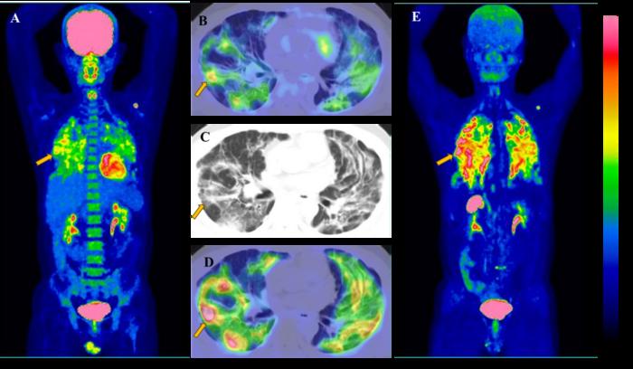 Male, 46 years old, with IIP for 1 month, manifests FDG and FAPI imaging positive