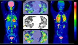 Male, 46 years old, with IIP for 1 month, manifests FDG and FAPI imaging positive