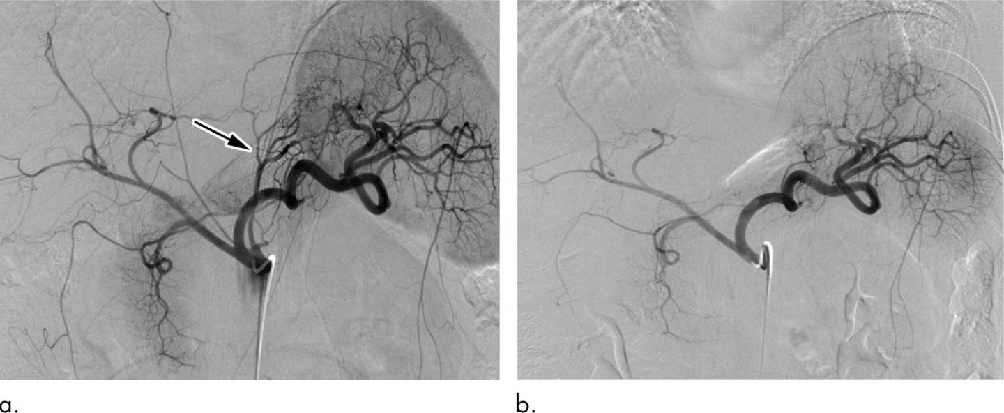 Bariatric Embolization Shows Promise in Treatment of Obesity