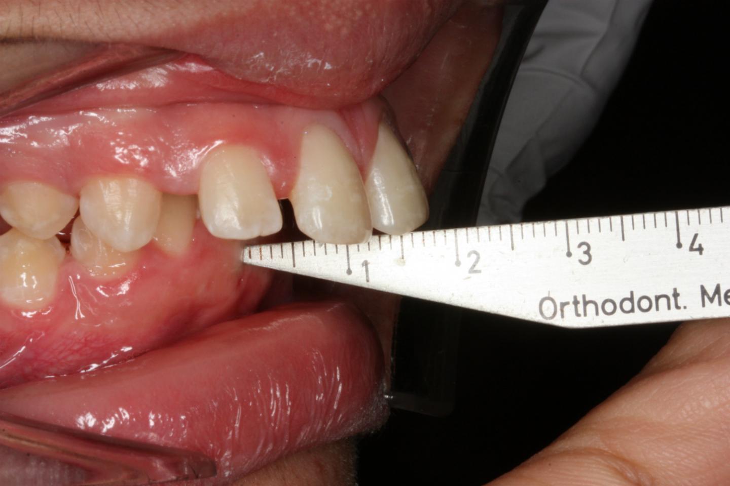 Measuring How Far Teeth Protrude