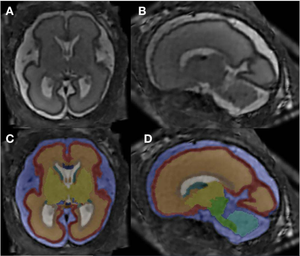 MRI Reveals Altered Brain Structure in Fetuses Exposed to Alcohol