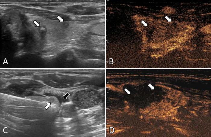 Ultrasound images in patient with multifocal papillary thyroid carcinoma