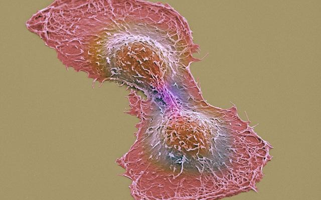 Scanning Electron Micrograph of Dividing Cancer Cells