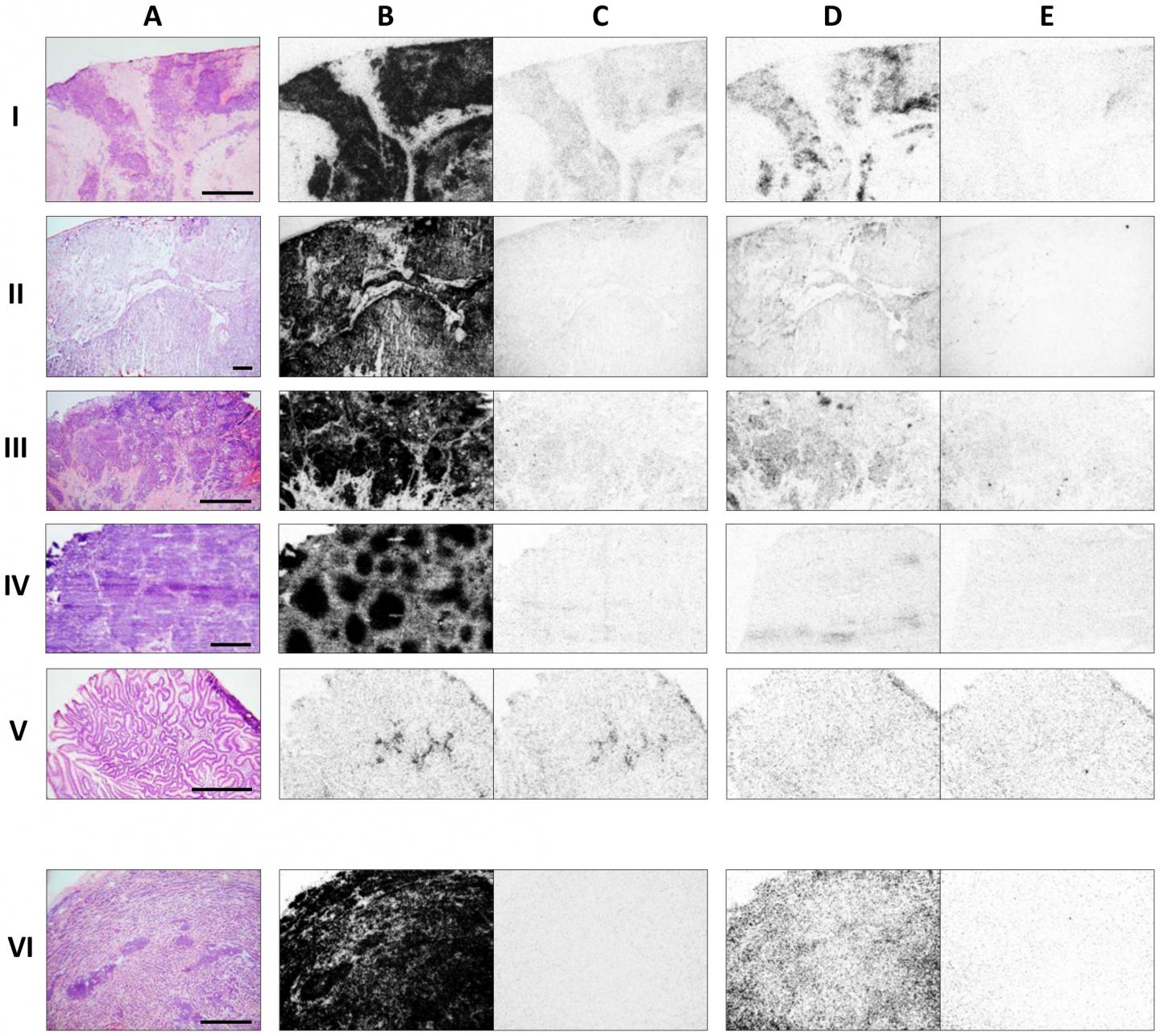 Comparative Receptor Autoradiography in Various Cancer Types