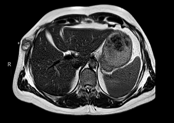 Complete response to encorafenib plus binimetinib in a BRAF V600E-mutant metastasic malignant glomus tumor