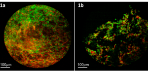 Examples of lung images using the MSCE instrument and the proflavine rose bengal dye combination.