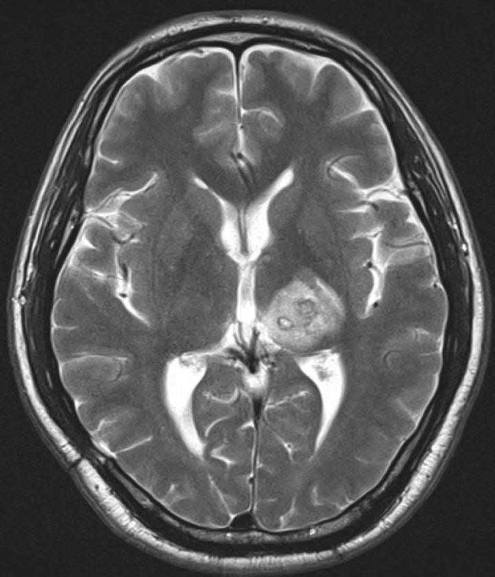 Brain MRI Scan