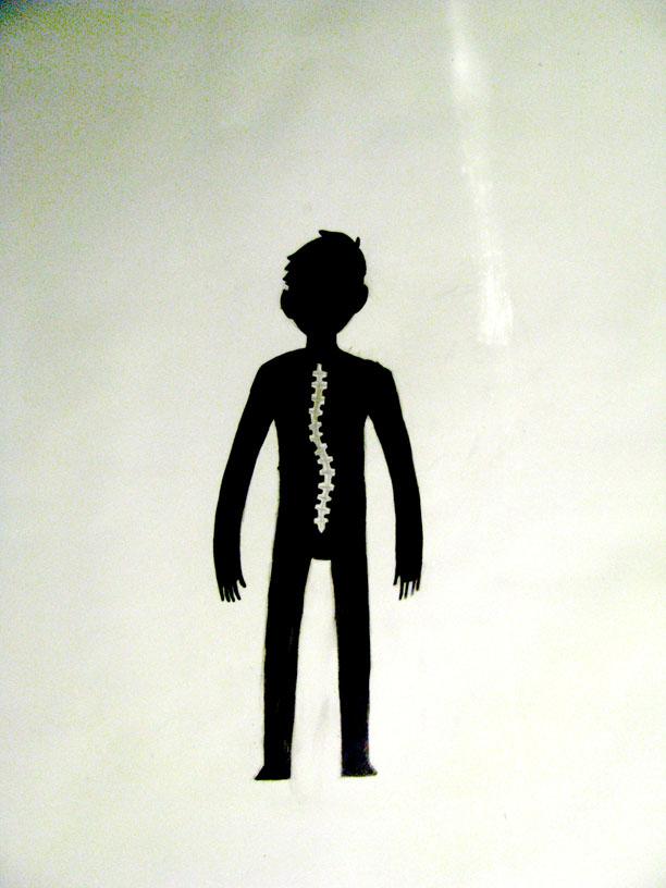Discovery of a Gene Responsible for Familial Scoliosis