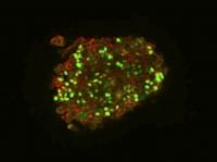 Human brain cancer cells expressing a stem cell marker