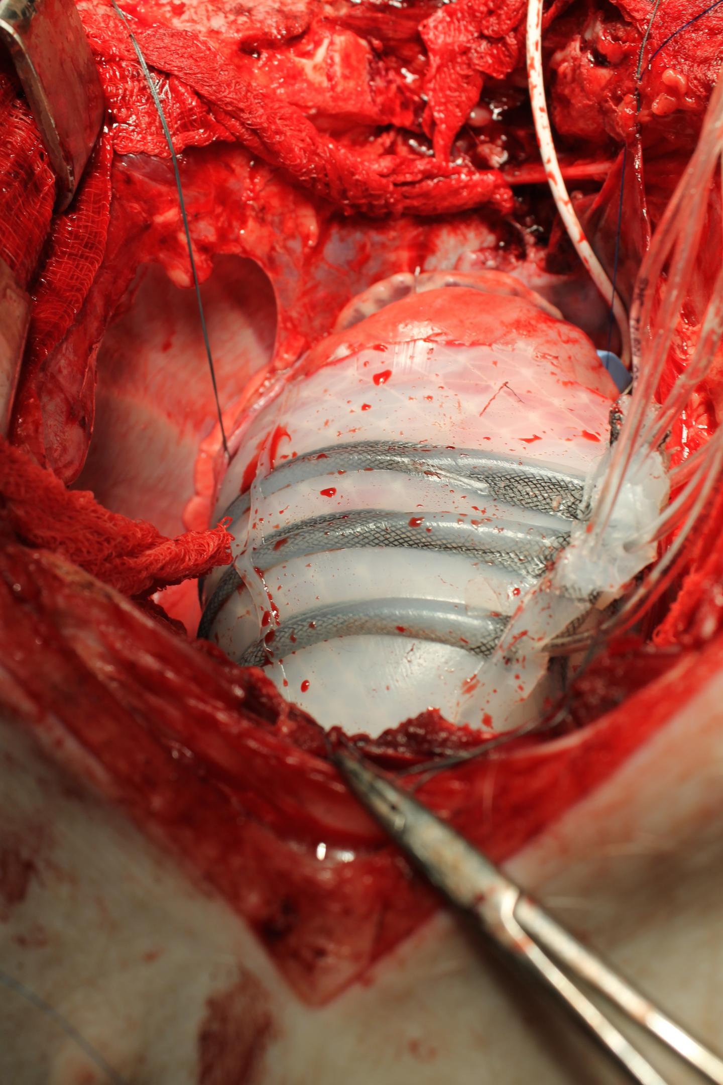 Soft Robotic Sleeve Supports Heart Function