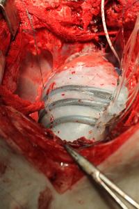 Soft Robotic Sleeve Supports Heart Function