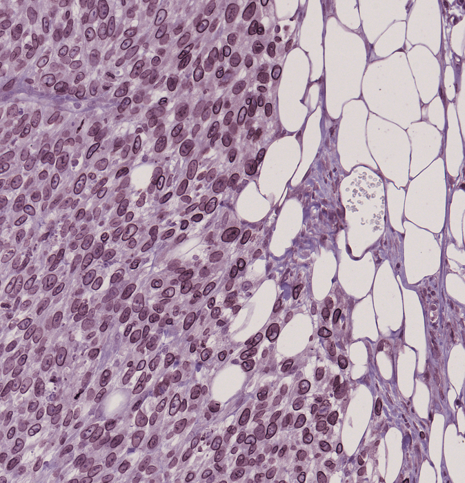 Image 2. Impact of LAP1 expression levels on metastatic melanoma cells.