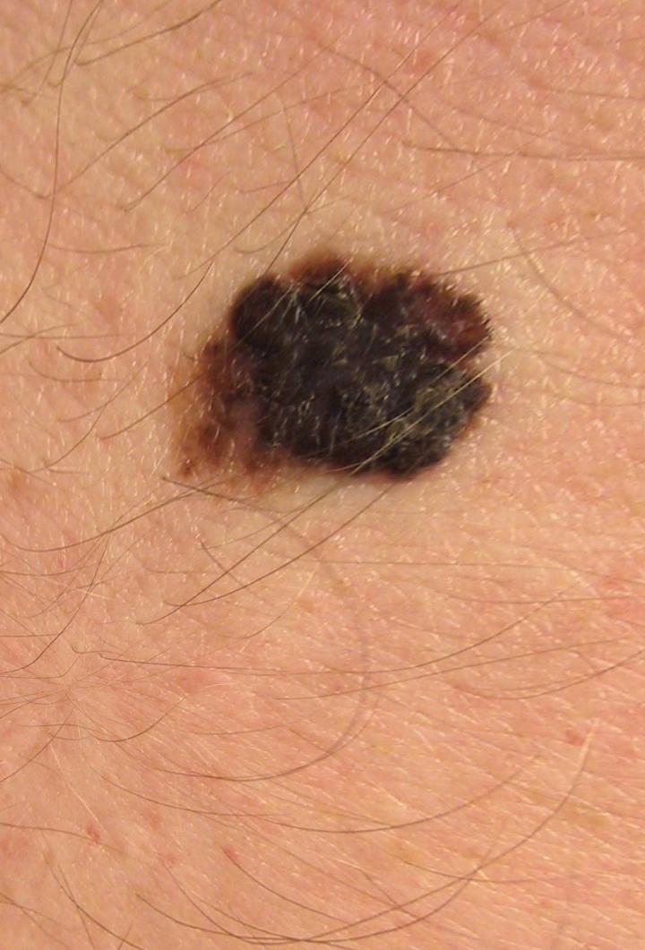Skin Nevus [IMAGE] EurekAlert! Science News Releases