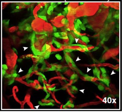 Brain Tumor Blood Vessels