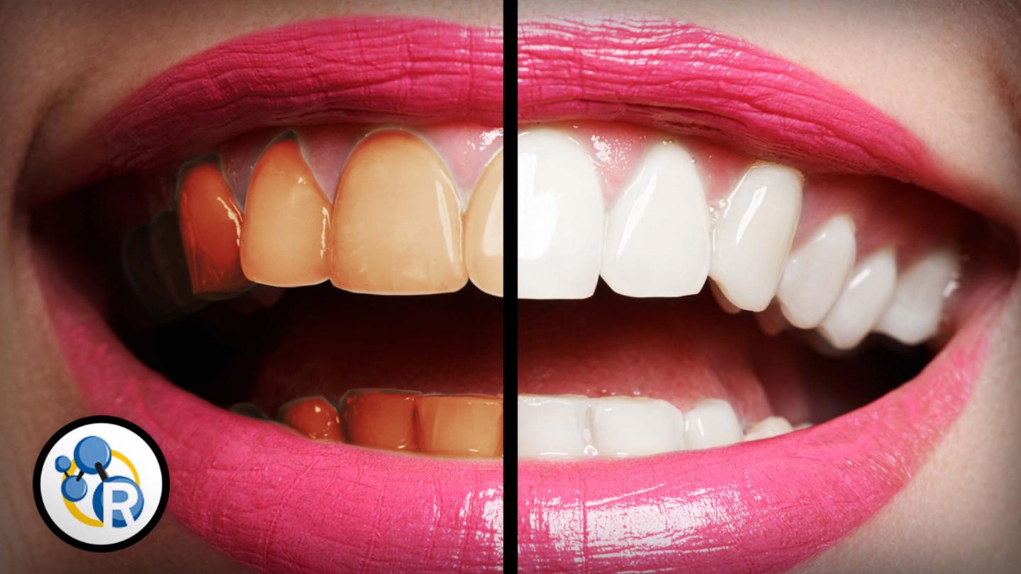 What Is the Best Way to Whiten Teeth?
