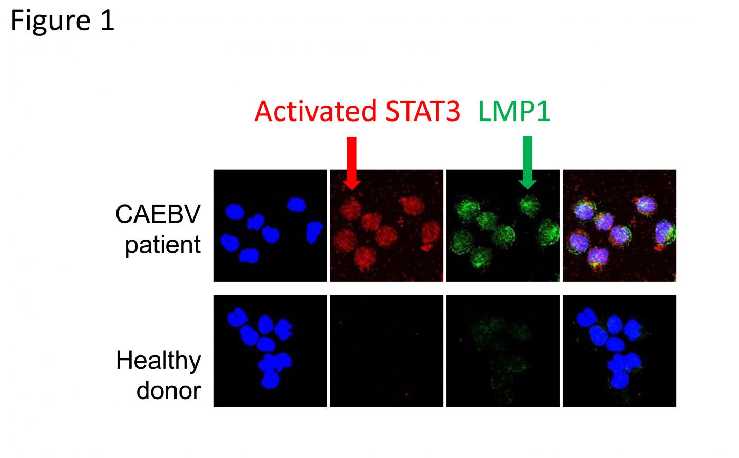 Figure 1 STAT3 Activation in EBV-infected Cells from a Chronic Active EBV Infection (CAEBV) Patient