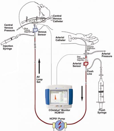 measuring central venous pressure