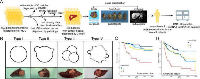 The prognosis of patients with HCC varies depending on their gross subtype.