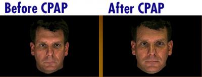 Before and After CPAP