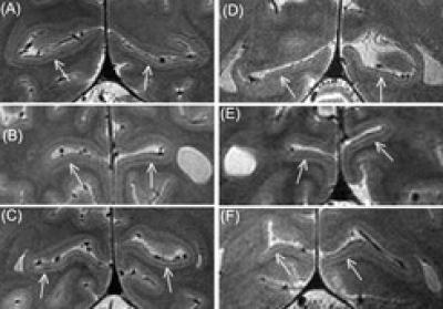fMRI Image of the Stripe of Gennari