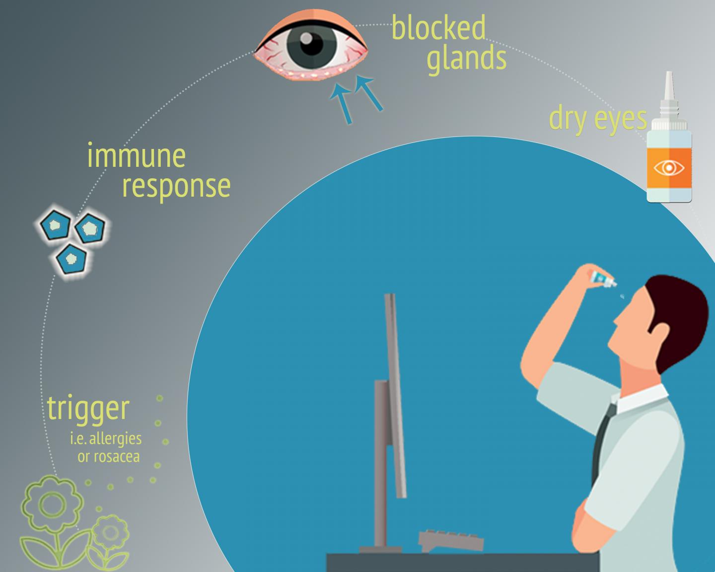 Immune Response Likely Culprit in Eyelid Gland Condition That Causes Dry Eye