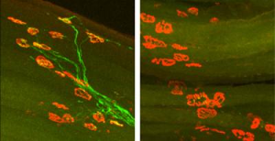 Scientists Identify Protein Required to Regrow Injured Nerves in Limbs
