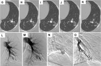 Smoking Impedes Embolization Treatment in Lungs - Image 3