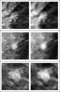 Soft tissue lesions