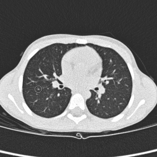 Indeterminate Pulmonary Nodules on CT-scan