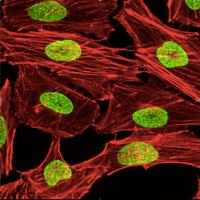 Melanoma cells create more nuclear pores (green) than normal cells.