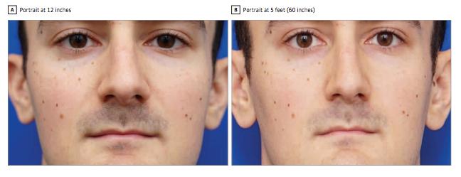 Example of Nasal Size Distortion in a Short-Distance Photograph and Derived Model