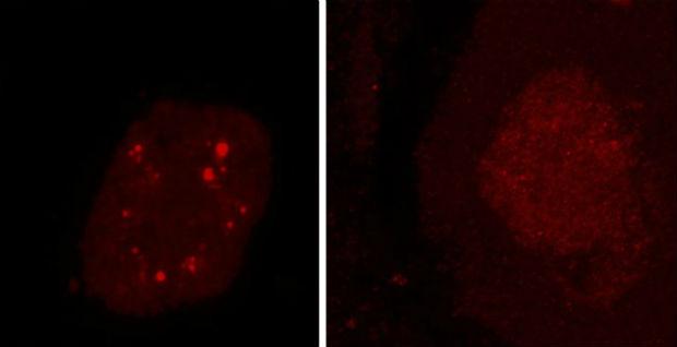 Protein Clumps Seen in ALS vs. Healthy Cells