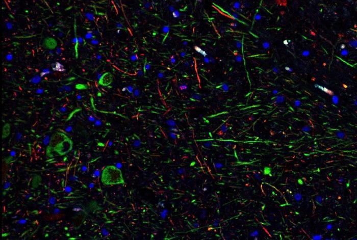 Stained tissue from the midbrain of a COVID-19 patient shows DNA in the cells' nuceli (blue), dopamine neurons (green) and phosphor-alpha-synuclein (red)