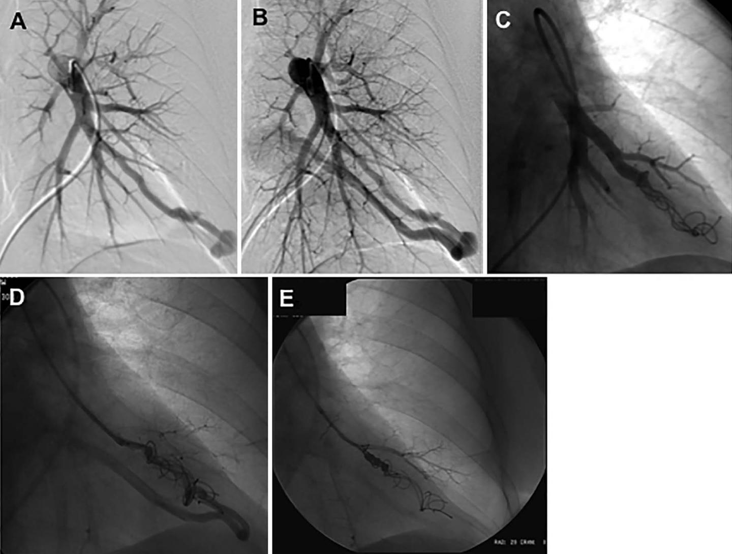 Smoking Impedes Embolization Treatment in Lungs