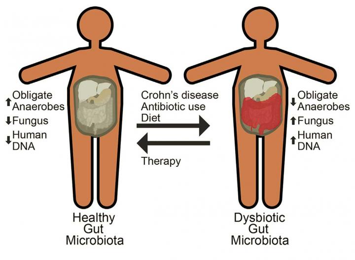 Dysbiosis in Crohn's