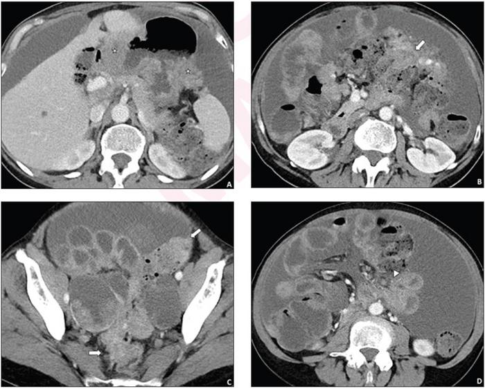 62-year-old woman who underwent pretreatment CT for suspected advanced ovarian cancer