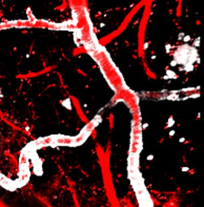 Amyloid in the Living Brain