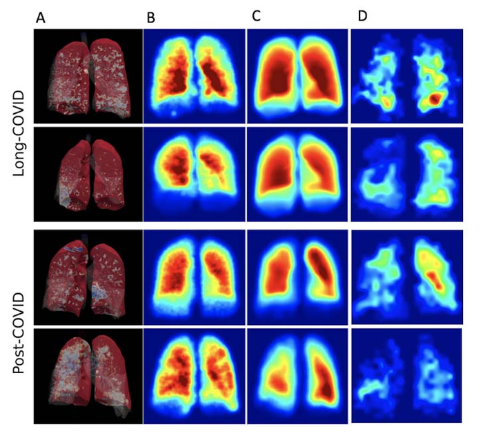 MRI Finds Lung Abnormalities in Non-Hospitalized Long COVID Patients