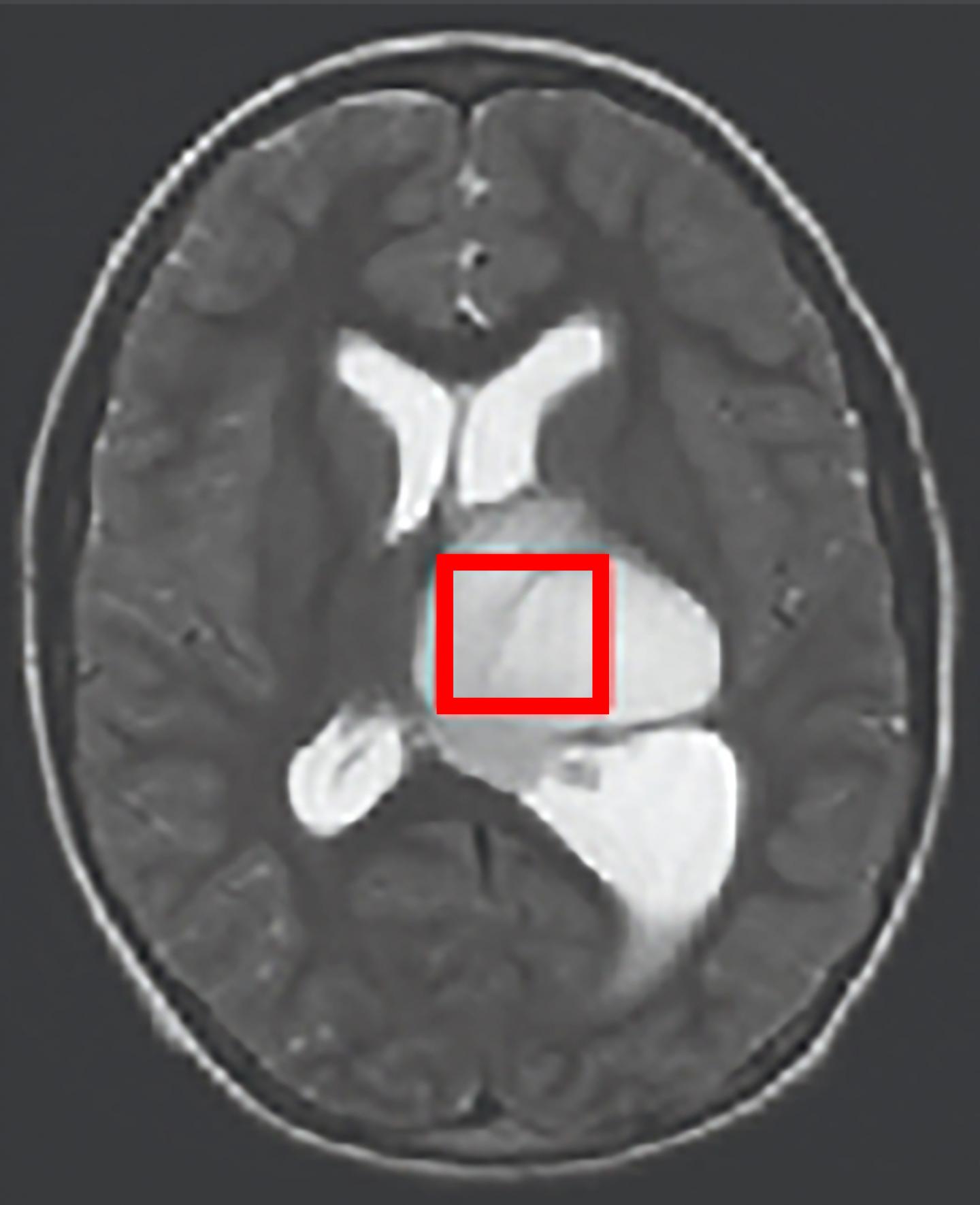 Combating Brain Tumor Metabolism