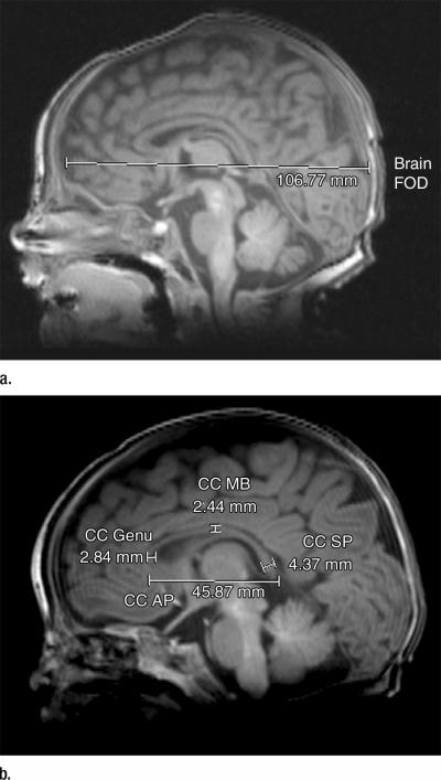 Brain Fronto-Occipital Distance